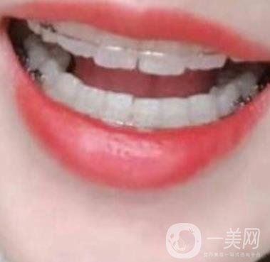 廣東省口腔醫(yī)院正畸價格表及案例恢復過程分享