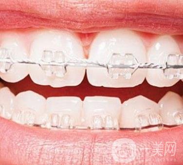 廣東省口腔醫(yī)院正畸價格表及案例恢復過程分享