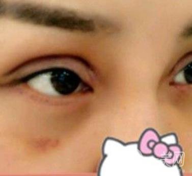 廣西醫(yī)科大一附院去眼袋怎么樣?整形價(jià)格表及案例*果圖分享