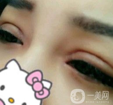 廣西醫(yī)科大一附院去眼袋怎么樣?整形價(jià)格表及案例*果圖分享