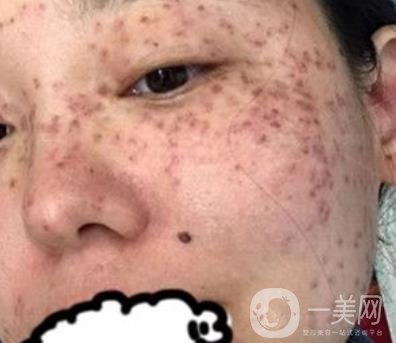 哈醫(yī)大四院整形美容科*新價(jià)格表公布,附祛斑真人案例