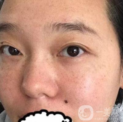 哈醫(yī)大四院整形美容科*新價(jià)格表公布,附祛斑真人案例