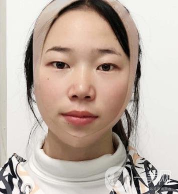 南京鼓樓醫(yī)院整形科價(jià)格表（價(jià)格）,及磨骨阿案例日記分享