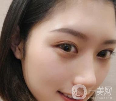 青醫(yī)附院王彥進去痣怎么樣？價格表及*果展示