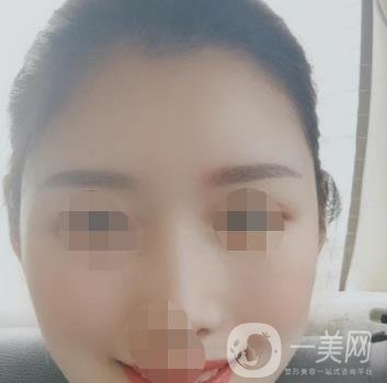 青醫(yī)附院王彥進去痣怎么樣？價格表及*果展示