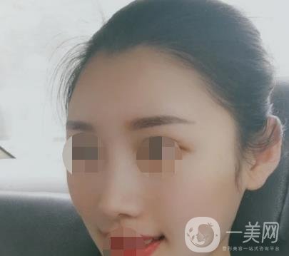 青醫(yī)附院王彥進去痣怎么樣？價格表及*果展示