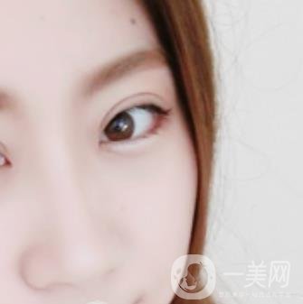 沈陽(yáng)百嘉麗醫(yī)院價(jià)格表2020，附雙眼皮案例分享