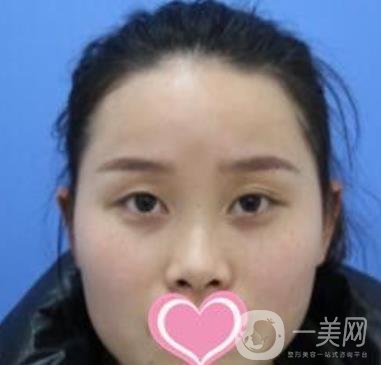 沈陽名流整形醫(yī)院價(jià)格表，附雙眼皮+隆鼻案例