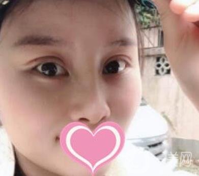 沈陽名流整形醫(yī)院價(jià)格表，附雙眼皮+隆鼻案例