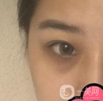 沈陽(yáng)杏林整形醫(yī)院割雙眼皮*果咋樣?看實(shí)例及價(jià)格表