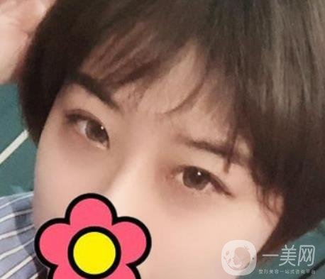 沈陽(yáng)杏林整形醫(yī)院割雙眼皮*果咋樣?看實(shí)例及價(jià)格表