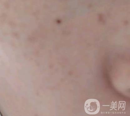 上海星和醫(yī)美整形醫(yī)院*祛斑*果圖和價(jià)格價(jià)目表2020年