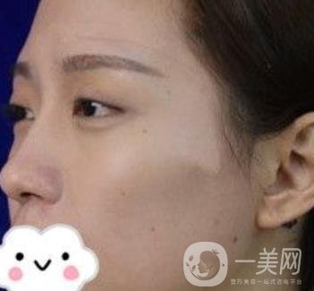 臺州博雅美惠醫(yī)療美容整形雙眼皮恢復(fù)日記，內(nèi)附價格表明細