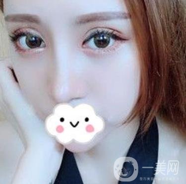 臺州博雅美惠醫(yī)療美容整形雙眼皮恢復(fù)日記，內(nèi)附價格表明細