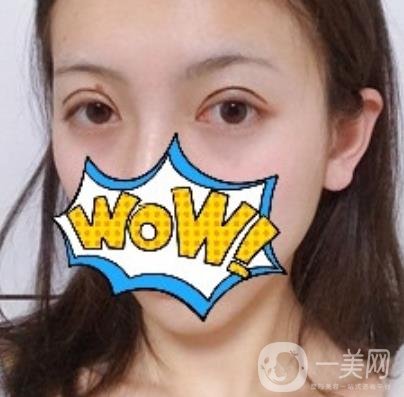 武漢艾萊美醫(yī)療整形醫(yī)院價格表項目收費明細，附雙眼皮案例