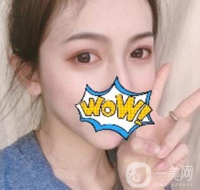 武漢艾萊美醫(yī)療整形醫(yī)院價格表項目收費明細，附雙眼皮案例