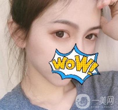 武漢艾萊美醫(yī)療整形醫(yī)院價格表項目收費明細，附雙眼皮案例