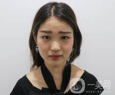 西安華旗唯美整形醫(yī)院做*多少錢？價格表收費(fèi)明細(xì)和案例分享