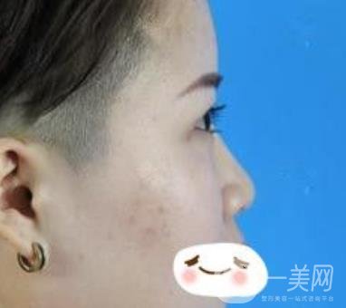 四川省人民醫(yī)院整形科駝峰鼻矯正多少錢？價格表2020更新