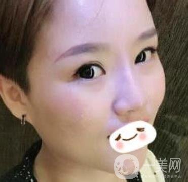 四川省人民醫(yī)院整形科駝峰鼻矯正多少錢？價格表2020更新