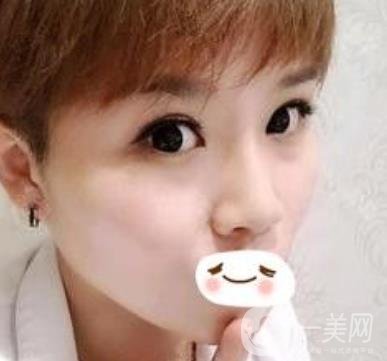 四川省人民醫(yī)院整形科駝峰鼻矯正多少錢？價格表2020更新