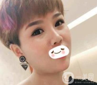 四川省人民醫(yī)院整形科駝峰鼻矯正多少錢？價格表2020更新