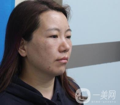 廣州壹加壹整形醫(yī)院做雙眼皮咋樣?案例+價格表詳覽