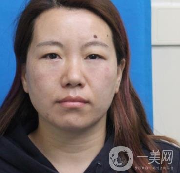 廣州壹加壹整形醫(yī)院做雙眼皮咋樣?案例+價格表詳覽