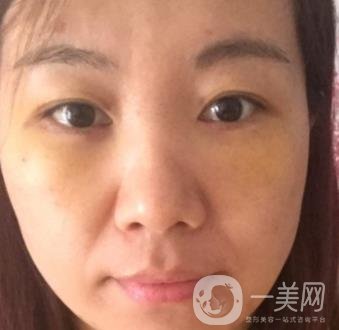 廣州壹加壹整形醫(yī)院做雙眼皮咋樣?案例+價格表詳覽