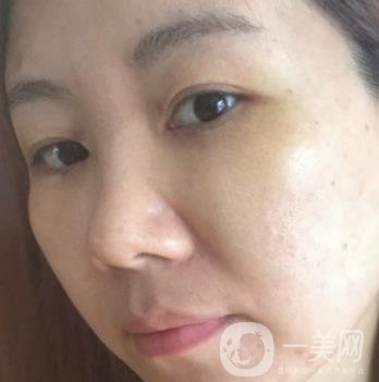 廣州壹加壹整形醫(yī)院做雙眼皮咋樣?案例+價格表詳覽