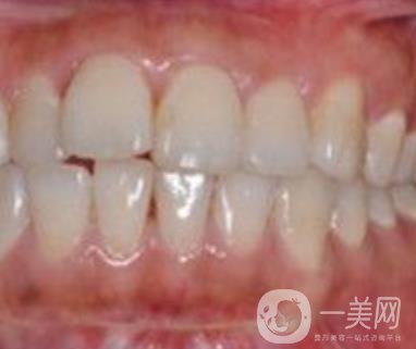 武漢大學口腔醫(yī)院牙齒矯正多少錢?*果好嗎?價格費用明細一覽