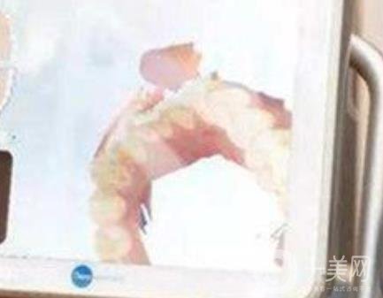 武漢大學口腔醫(yī)院牙齒矯正多少錢?*果好嗎?價格費用明細一覽