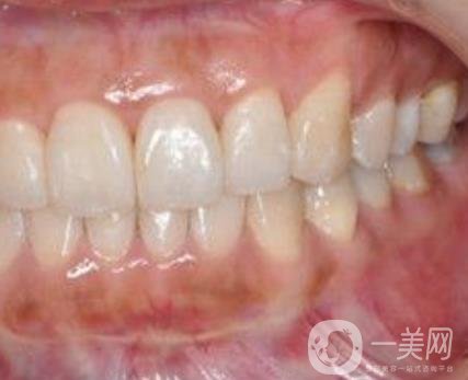 武漢大學口腔醫(yī)院牙齒矯正多少錢?*果好嗎?價格費用明細一覽