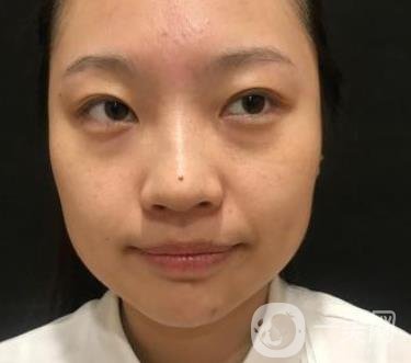 北京知音醫(yī)療美容熱瑪吉*果怎么樣？貴嗎？收費價格表2020公布