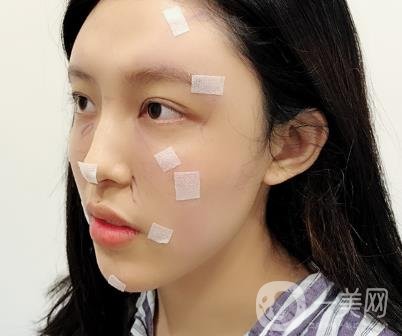 成都美容整形醫(yī)院做脂肪填充全臉*果靠譜嗎?近期價(jià)格表和案例參考