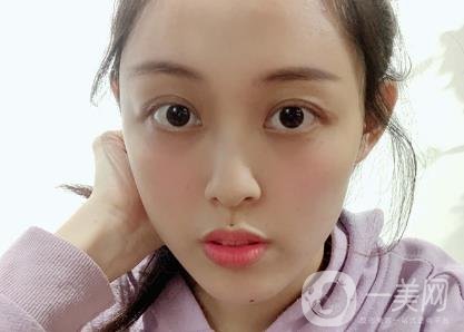 成都美容整形醫(yī)院做脂肪填充全臉*果靠譜嗎?近期價(jià)格表和案例參考