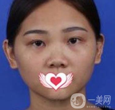 交大一附院王瑞做鼻子怎么樣？?jī)r(jià)格表及術(shù)后*果分享
