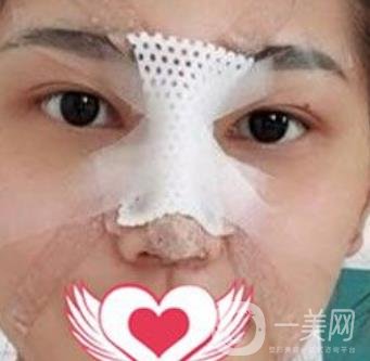交大一附院王瑞做鼻子怎么樣？?jī)r(jià)格表及術(shù)后*果分享