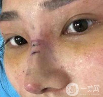 交大一附院王瑞做鼻子怎么樣？?jī)r(jià)格表及術(shù)后*果分享