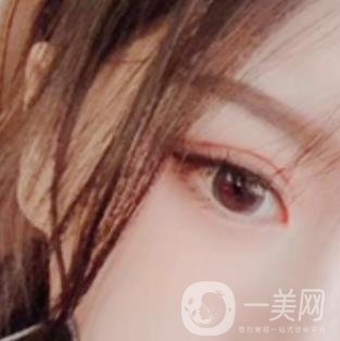 徐州亞韓整形醫(yī)院價格表2020新版+雙眼皮整形日記一覽