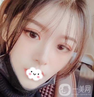 徐州亞韓整形醫(yī)院價格表2020新版+雙眼皮整形日記一覽