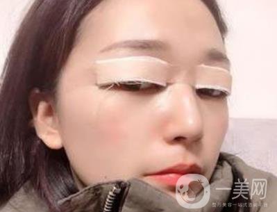 恩施州中心醫(yī)院美容整形科怎么樣？價格表和雙眼皮整形經(jīng)歷分享