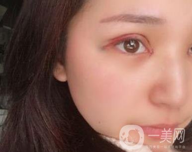 恩施州中心醫(yī)院美容整形科怎么樣？價格表和雙眼皮整形經(jīng)歷分享