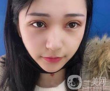 恩施州中心醫(yī)院美容整形科怎么樣？價格表和雙眼皮整形經(jīng)歷分享