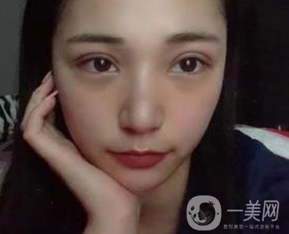 恩施州中心醫(yī)院美容整形科怎么樣？價格表和雙眼皮整形經(jīng)歷分享