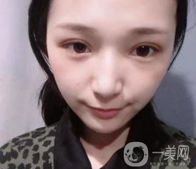 恩施州中心醫(yī)院美容整形科怎么樣？價格表和雙眼皮整形經(jīng)歷分享