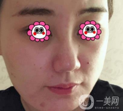 鼓樓醫(yī)院可以打*嗎?附案例恢復(fù)圖及整形價格表