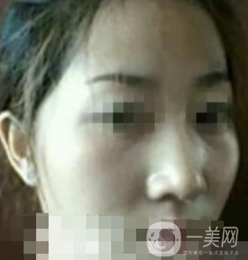 河南省人民醫(yī)院脂肪填充