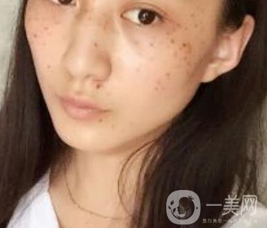 安醫(yī)一附院整形外科價(jià)格表2020版，還有激光祛斑案例