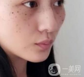 安醫(yī)一附院整形外科價(jià)格表2020版，還有激光祛斑案例